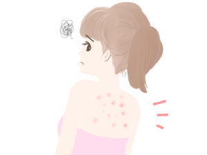 背中のニキビがかゆい！ガンコな背中ニキビをすぐに治す方法！